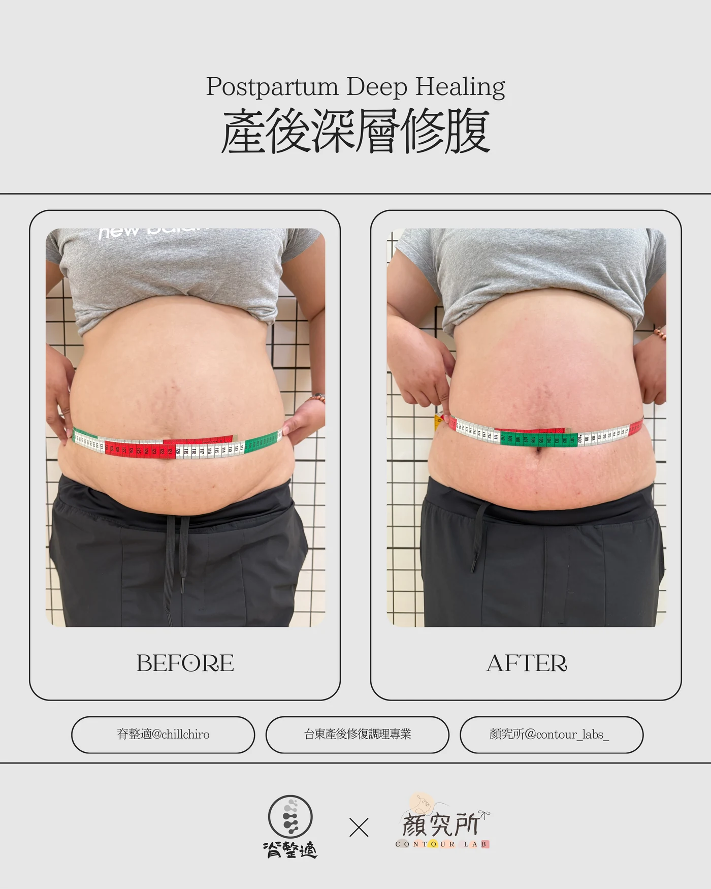 脊整適產後腹部重塑真實案例，腰腹調理前後對比
