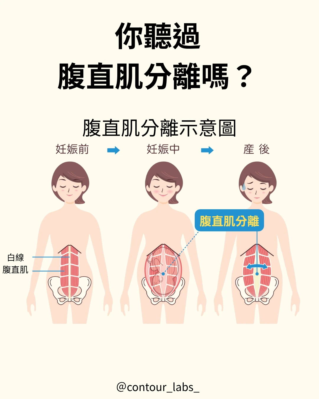 懷孕前中後腹直肌分離變化示意圖