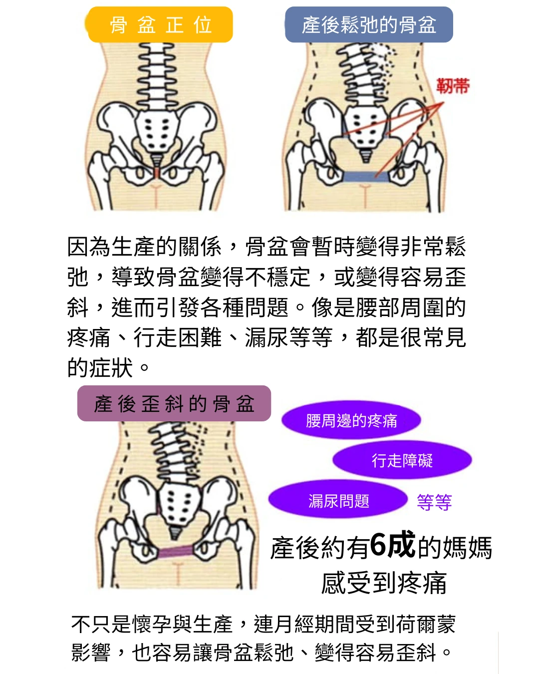 產後骨盆鬆弛與歪斜示意圖