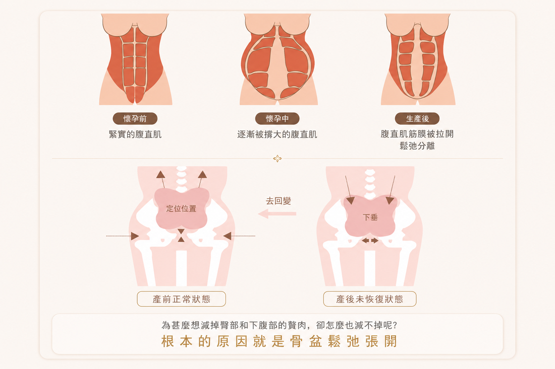 產後腹直肌分離與骨盆核心結構變化示意圖